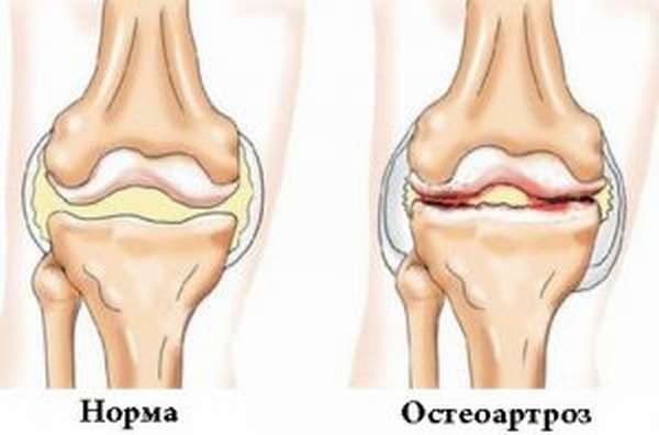 Остеоартроз