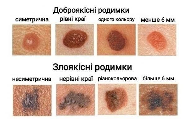 Такі родимки мають насторожити