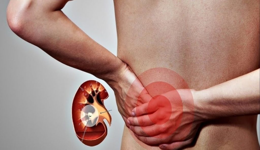 камінь у нирках