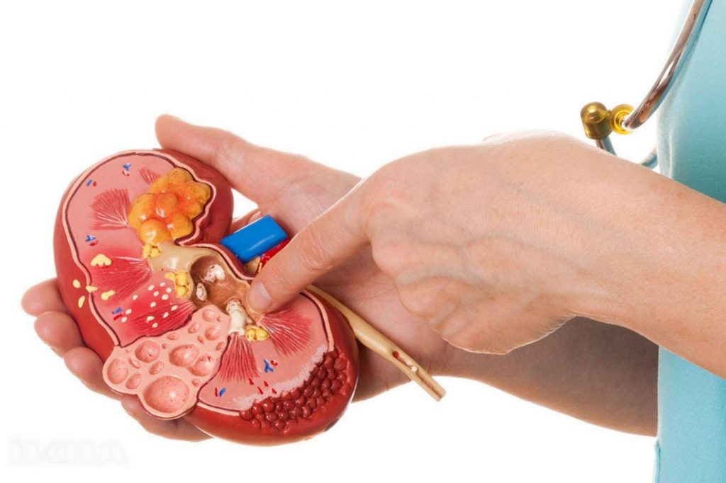 камінь у нирках