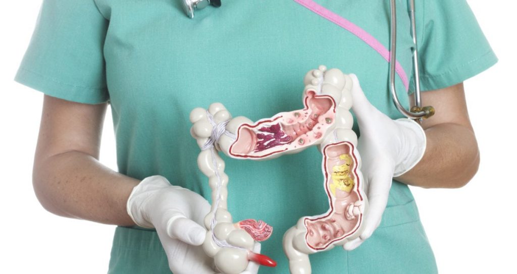 Синдром подразненого кишківника