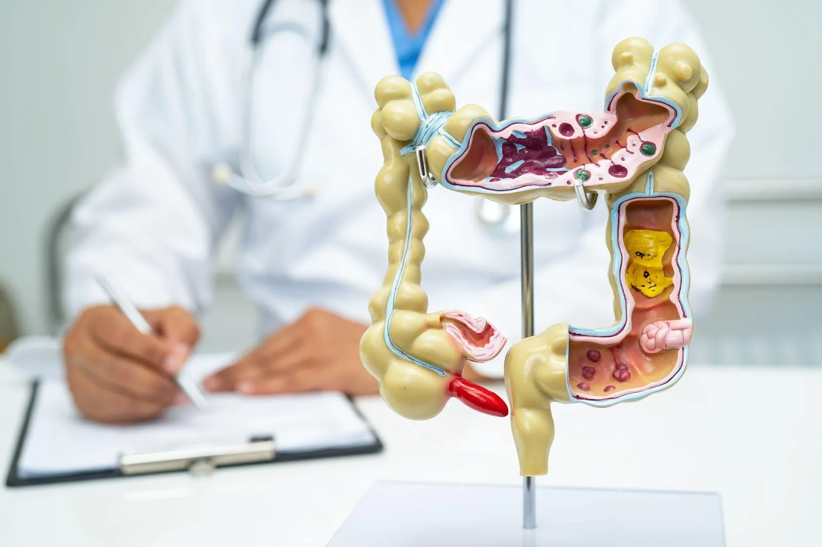 Колоректальний рак: діагностика і лікування