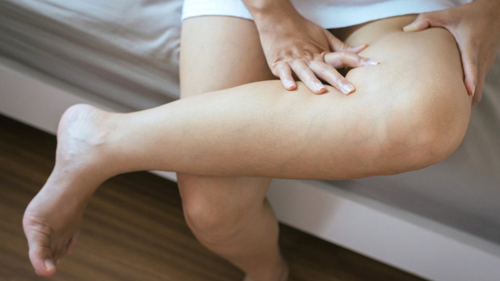 Тромбоз глибоких вен