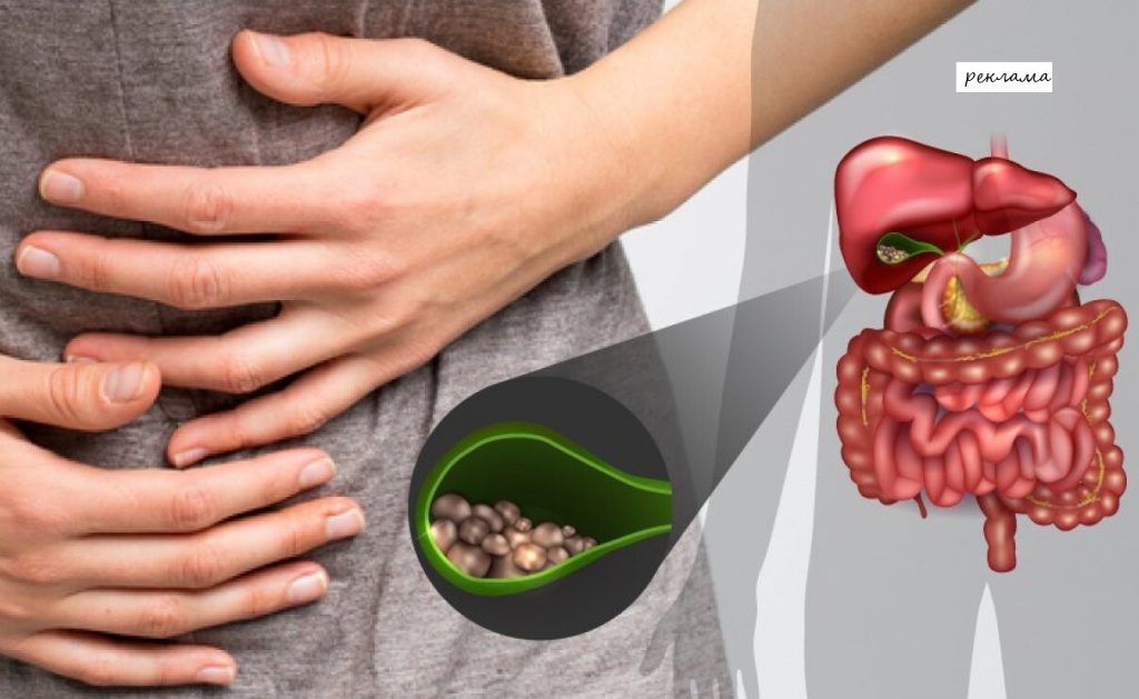 жовчнокам'яна хвороба