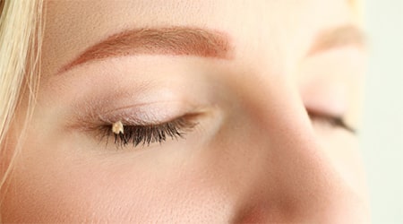 після видалення папіломи