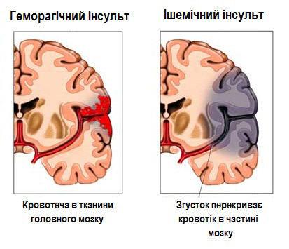 Мозок під час інсульту